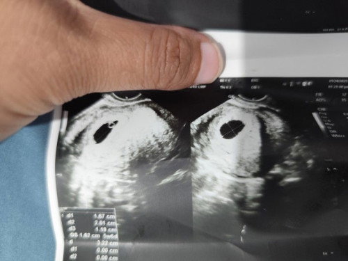 have first miscarriage before