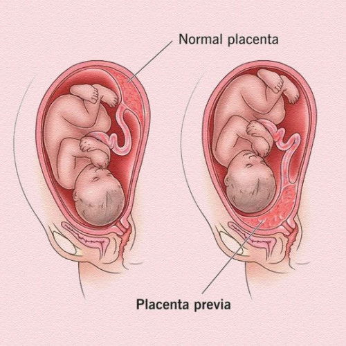 Hello momshie!☺️
Meron po ba dito same case ko po asa baba ang placenta previa?