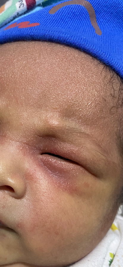 Usia 4hari wajah Anak bintik