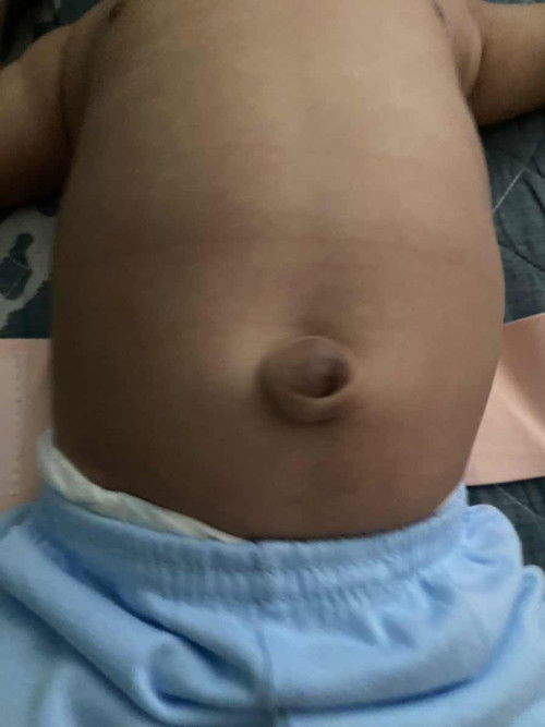 Infantile umbilical hernia