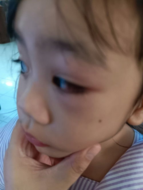 Paano Ang Lunas sa pamamaga ng mata dahil sa sobrang pag bahing?