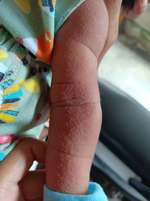 Solusi untuk kulit bayi kyak gini gimna yaa bund?