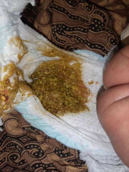 Pup bayi kayak gini aman ga yah?bisa sampe 7 kali pup, asi mix formula apakah aman?