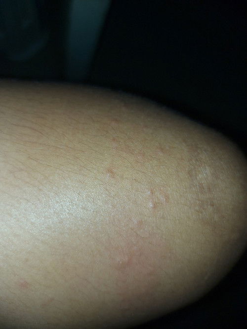 มีแม่ๆคนไหนเป็นผื่นใสๆคันๆขึ้นแบบนี้มั้ยคะ  แบบนี้ปกติมั้ยคะ