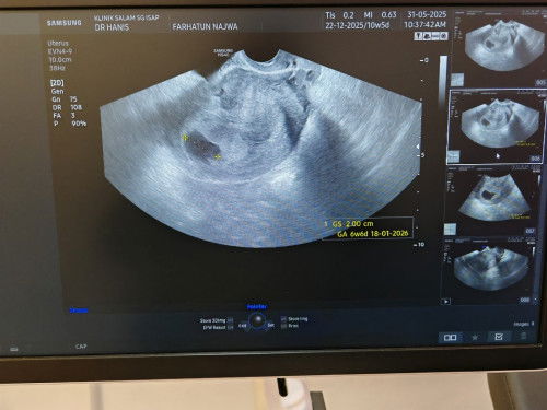 Missed Miscarriage at 10w6d