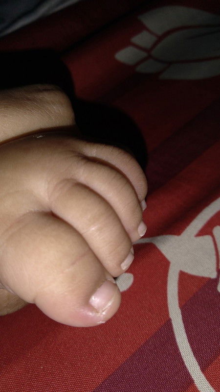 Cantengan pada bayi