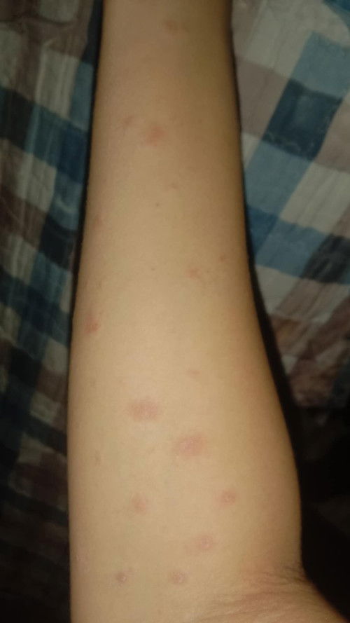 Rashes 14weeks pregnant