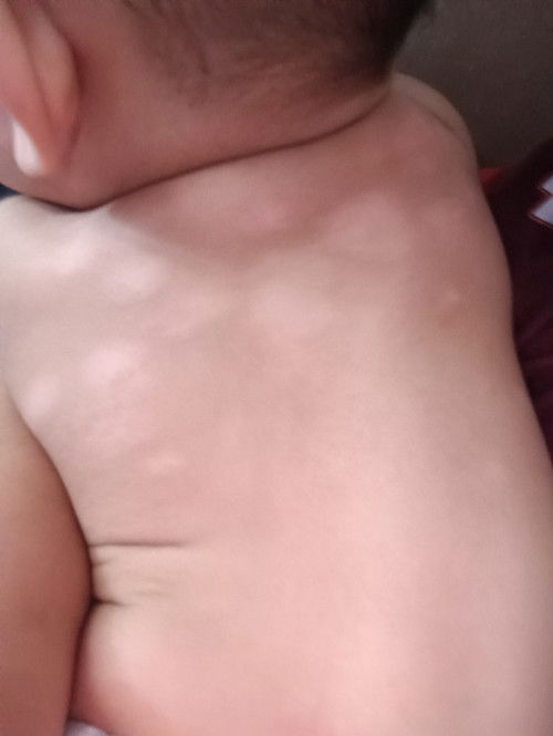 Hi... Mommy2 siapa tahu cara nak hilangkan parut ni bekas eczema dah Cuba mcm2 produk still sma je