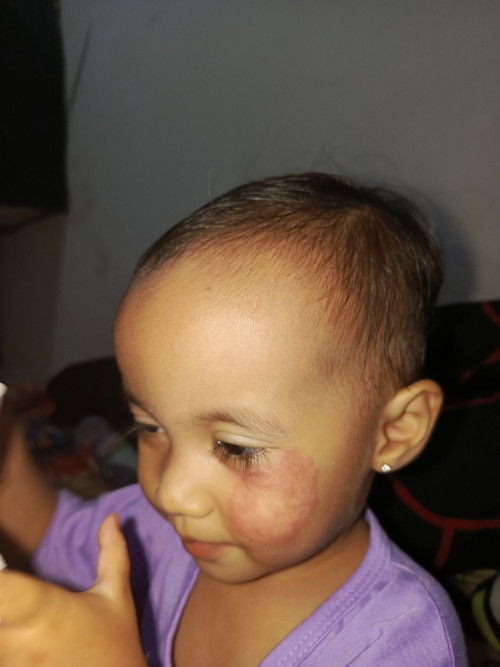 Ruam di wajah