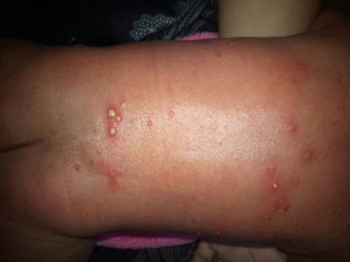 Bintik dipunggung bayi 15 hari