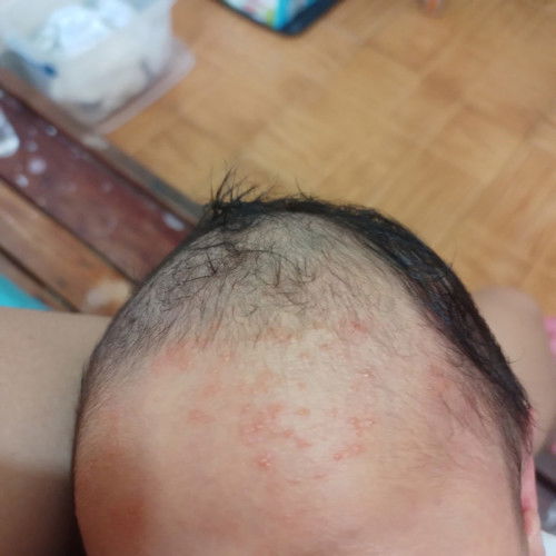 Baby Acne sa 2 Weeks Old Baby