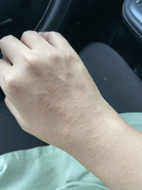 Allergic trimester 3