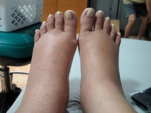 Ankle & feet edema