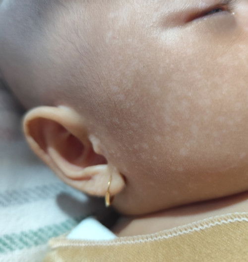 Bercak putih