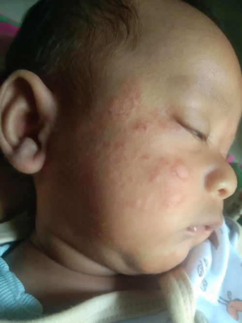wajah bayi merah² seperti kena roko