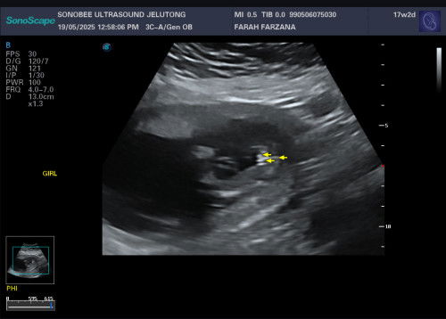 boy or girl