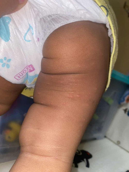 Bintik bintik di paha