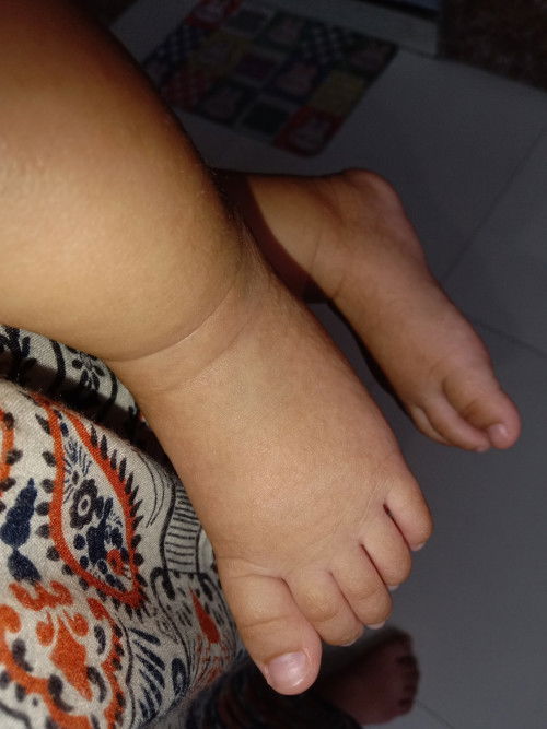 Kaki dan tangan bintik bintik kecil