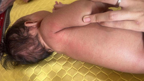 Ruam dikulit bayi