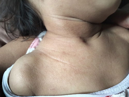 Anak suka gatal gatal gini knp ya bun? Anakku sering kya gini gtl2