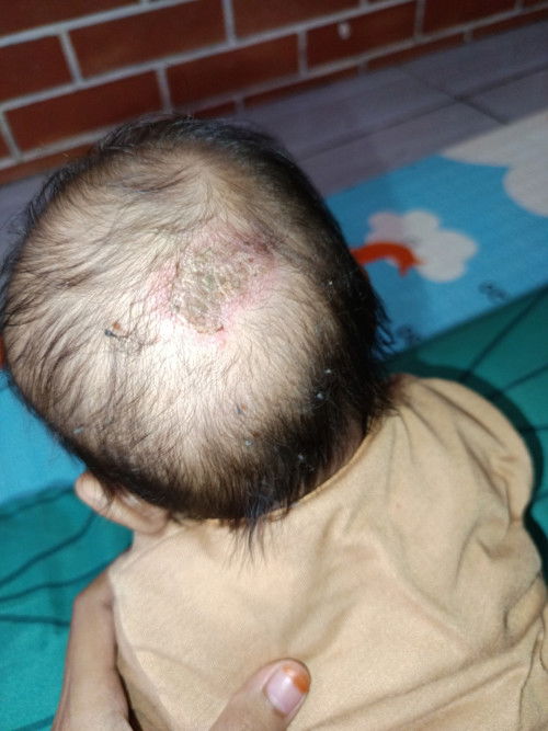 Merah di kepala belakang bayi