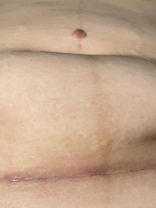 แผลฉีกไหมไหมคะแบบนี้