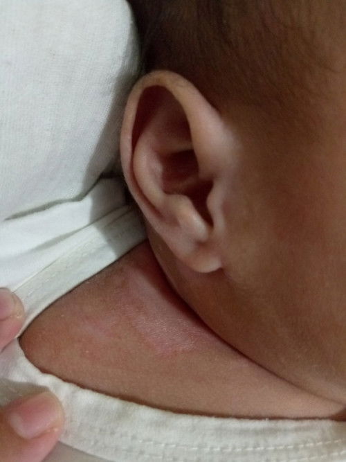 Skin problem ni baby