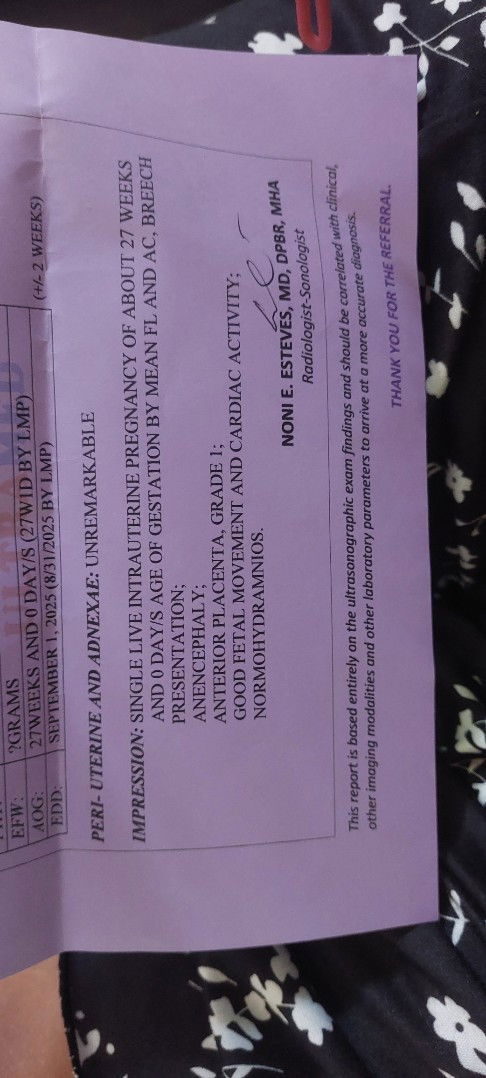 Anencephaly ang baby ko