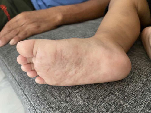 kesehatan anak
