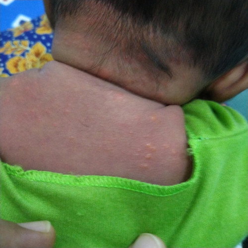 Bentol-bentol di sekitar leher pada bayi 2 bulan