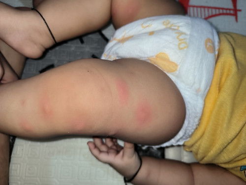 muncul bentol² merah setelah mpasi