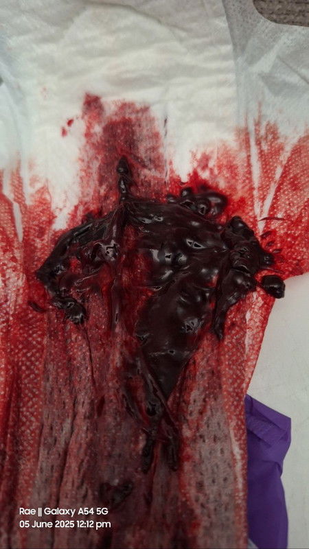 Postpartum Vaginal Bleeding
