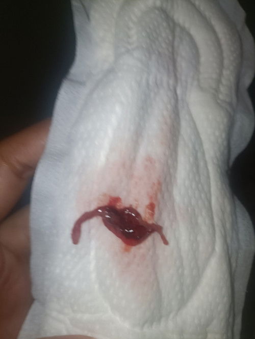 Normal po ba na may lumalabas na ganito ? 5 weeks palang po ako.