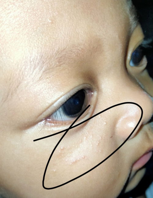 bintik bawah mata