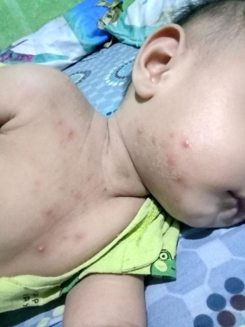 Biang kringet, bruntusan, sampe bisul kecil