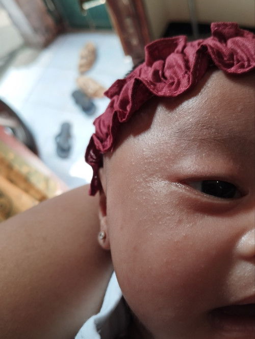 wajah bayi beruntusan