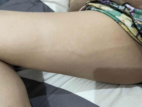 Garis panjang di paha hamil TM 2