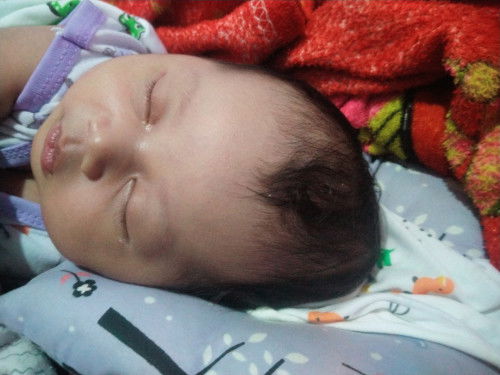 benjolan lunak di kepala bayi baru lahir