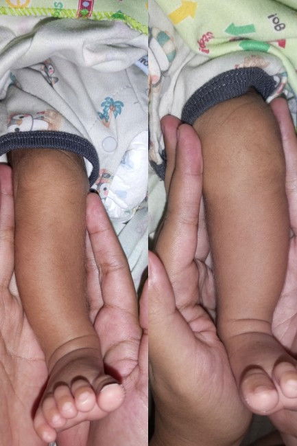 Bentuk kaki bayi sebulan seperti ini normal tidak ya