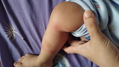 Bun ad yg tau ini apa ?? Ini timbul sehabis bayi sya demam, ad benjolan kecil berair d tengah2 ruam
