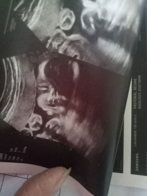 Pano poh basahin ung ultrasound koh any i ldea kung matangos ilong or hndi