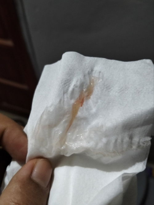 กระตุ้นคลอด คว้านปากมดลูก