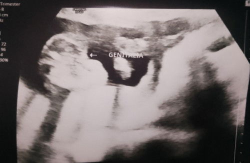 Gender in Ultrasound (Ob sono told that its Probably Female and may pinakita si Ob sono na 3 lines)