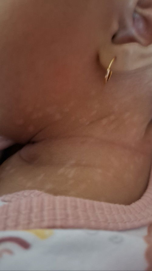 Bunda2 ada yang bayinya ngalamin ini ngga? Tipsnya agar bercak putihnya cepet hilang gimana yaa?