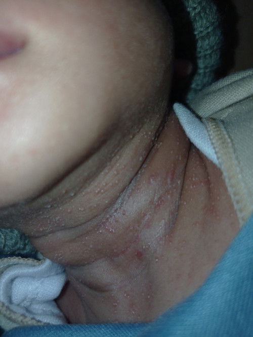 Mau tanya dong bun, bayi umur 1mg lehernya kek gini kenapa ya? Udh dikasih salep dokter gk mempan😭