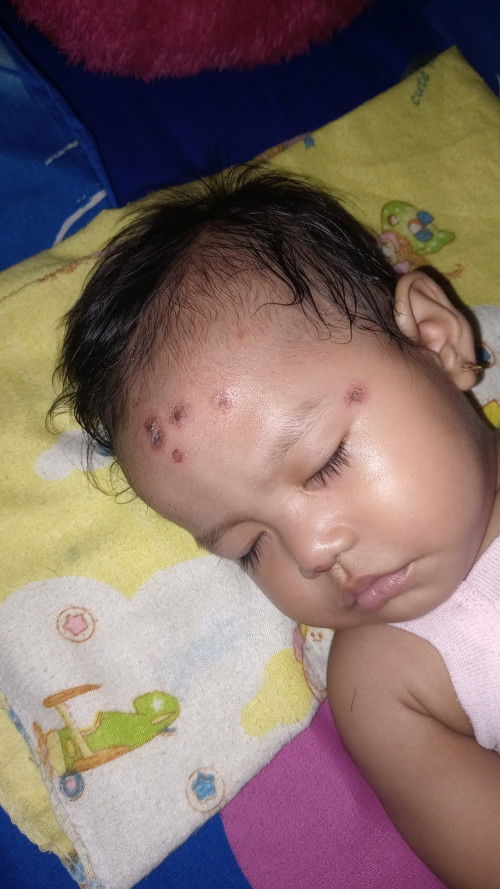 Halo bunda2, anaku kena cacar karna ketularan adik ipar, kira2 apa obat yang ampuh buat ilanginnya