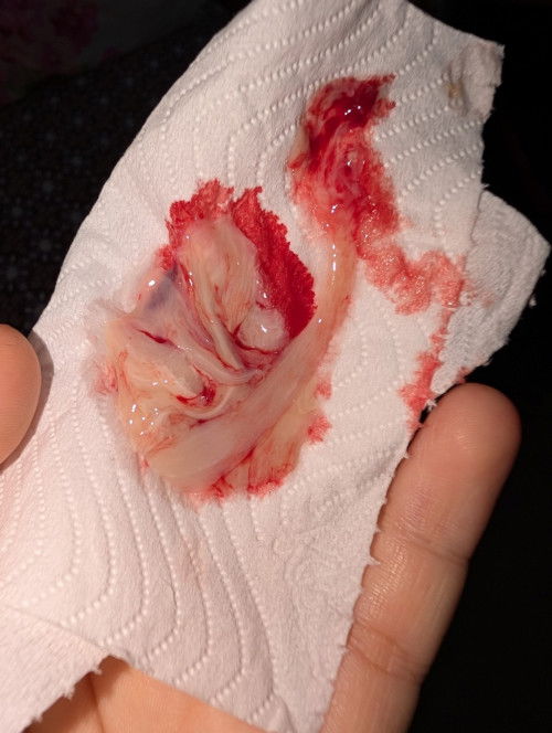 Breast Abscess kali ke 2