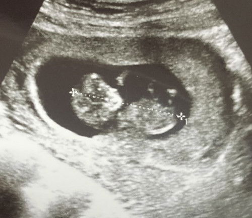 Gender baby