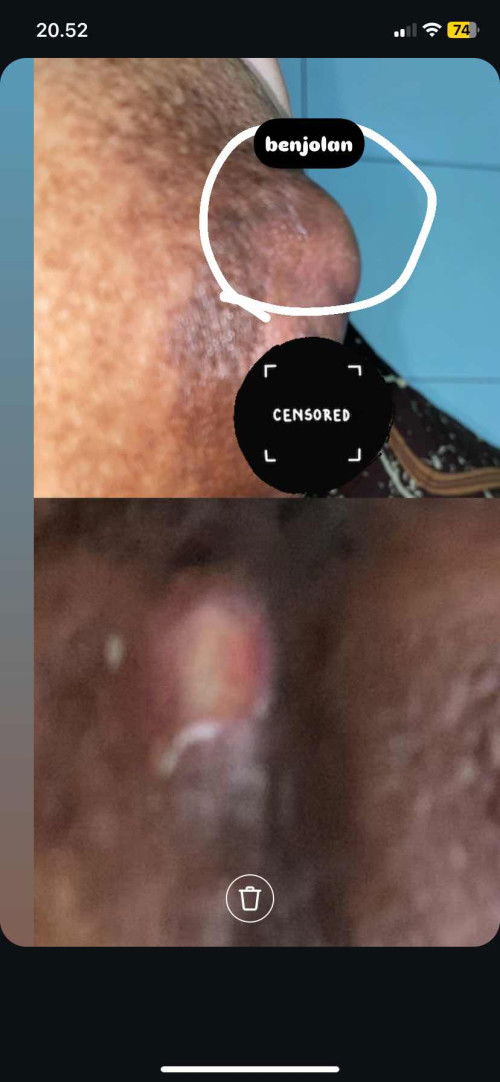 kena mastitis