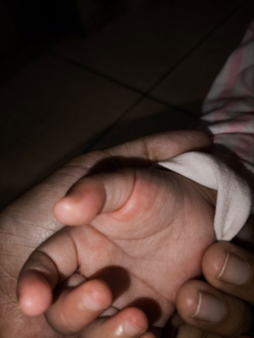Bayi 16 bulan telapak tangan dan punggung tangan bintik2 merah